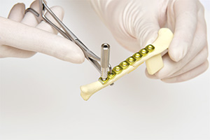 スクリューを挿入