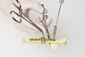 スクリューを挿入